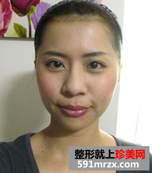 打瘦脸针实现了拥有鹅蛋脸的愿望