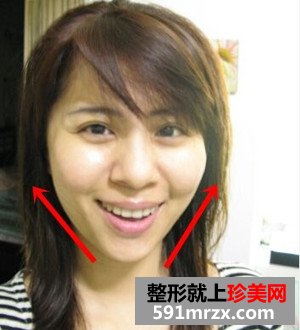 打瘦脸针实现了拥有鹅蛋脸的愿望
