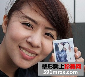 打瘦脸针实现了拥有鹅蛋脸的愿望