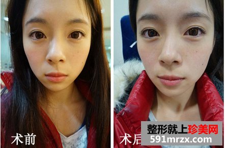 为了去法令纹果断注射乔雅登玻尿酸