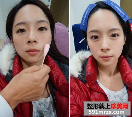 为了去法令纹果断注射乔雅登玻尿酸