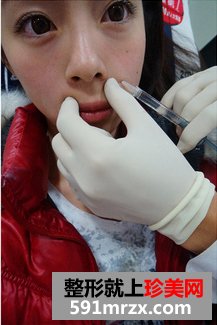 为了去法令纹果断注射乔雅登玻尿酸