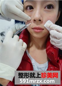 为了去法令纹果断注射乔雅登玻尿酸
