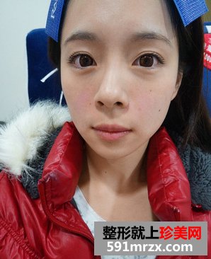 为了去法令纹果断注射乔雅登玻尿酸