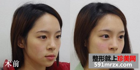 为了去法令纹果断注射乔雅登玻尿酸
