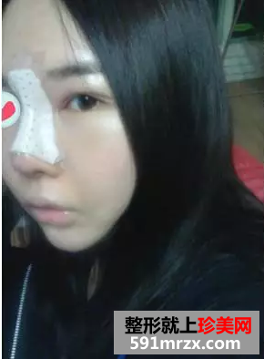 鼻整形成功案例对比图