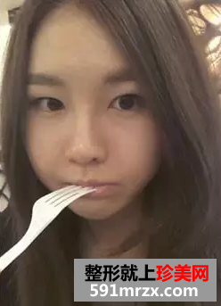 鼻整形成功案例对比图