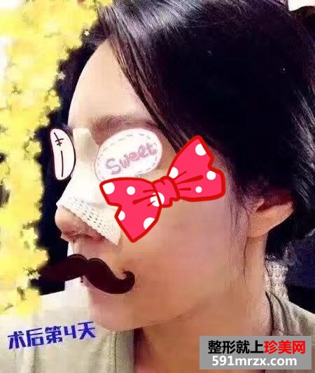 隆鼻真人成功案例对比图