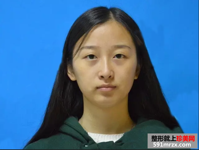 九院割双眼皮真实案例对比图