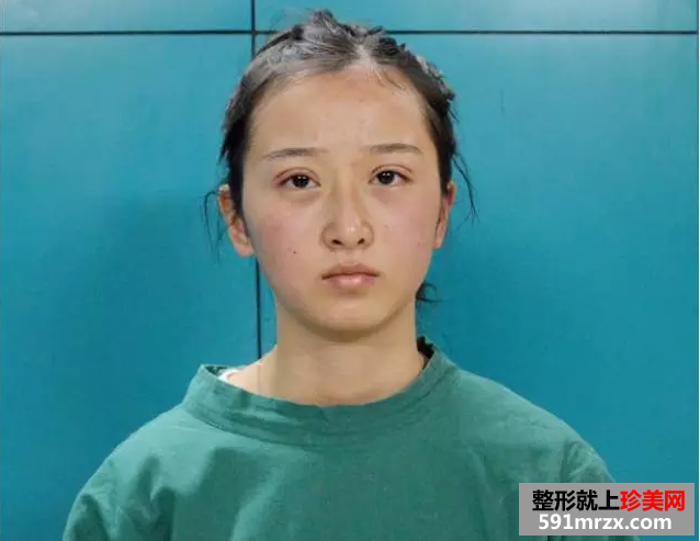 九院割双眼皮真实案例对比图