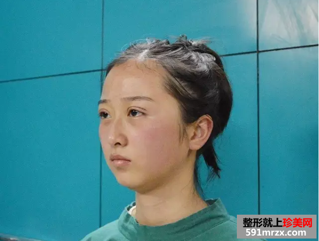 九院割双眼皮真实案例对比图