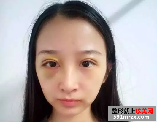 九院割双眼皮真实案例对比图