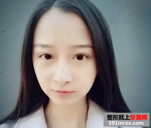 九院割双眼皮真实案例对比图