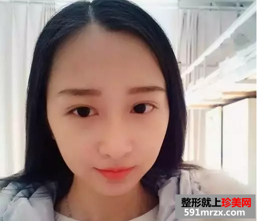 九院割双眼皮真实案例对比图