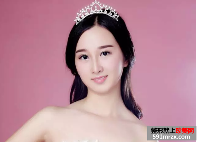 九院割双眼皮真实案例对比图