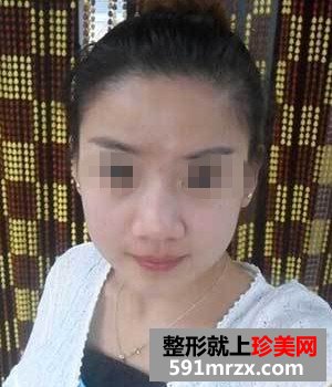 王军隆鼻真实案例对比图