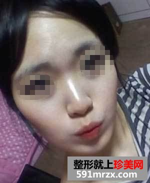 王军隆鼻真实案例对比图