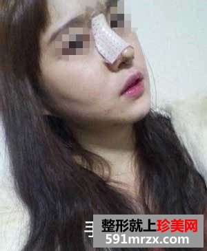 王军隆鼻真实案例对比图