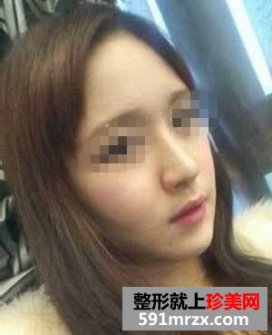 王军隆鼻真实案例对比图
