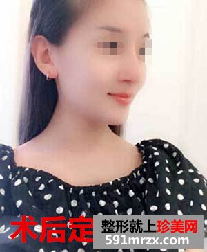 王军隆鼻真实案例对比图