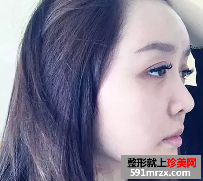 冯斌自体脂肪面部填充真人案例对比图