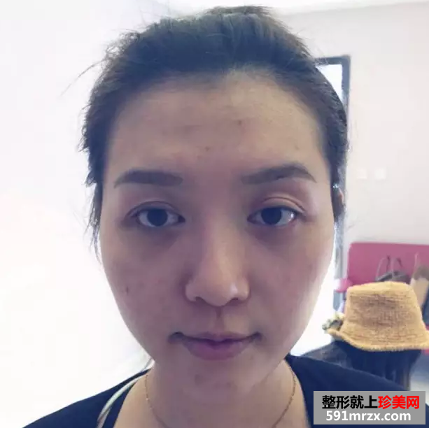 冯斌自体脂肪面部填充真人案例对比图
