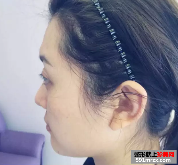 冯斌自体脂肪面部填充真人案例对比图