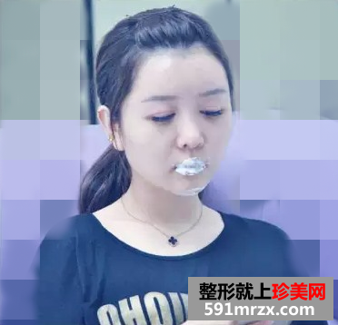 冯斌自体脂肪面部填充真人案例对比图
