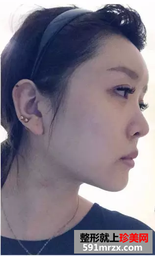 冯斌自体脂肪面部填充真人案例对比图