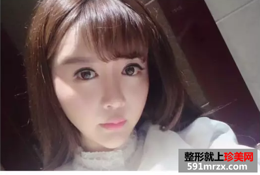 冯斌自体脂肪面部填充真人案例对比图