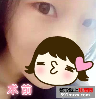 广州曙光全切双眼皮真人案例对比图