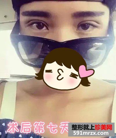 广州曙光全切双眼皮真人案例对比图