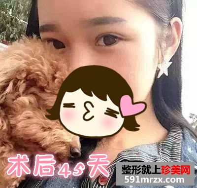 广州曙光全切双眼皮真人案例对比图