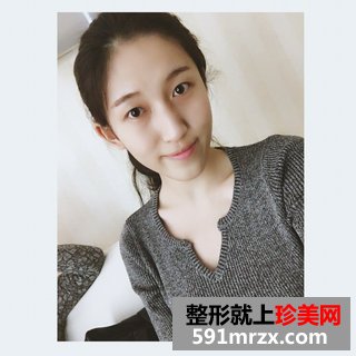 芭比双眼皮前后效果对比