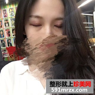 芭比双眼皮前后效果对比