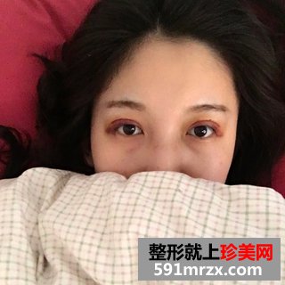芭比双眼皮前后效果对比