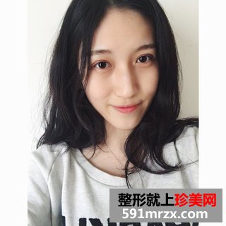 芭比双眼皮前后效果对比