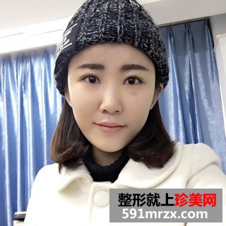 脂肪填充多久恢复自然 上海时光自体脂肪填充案例