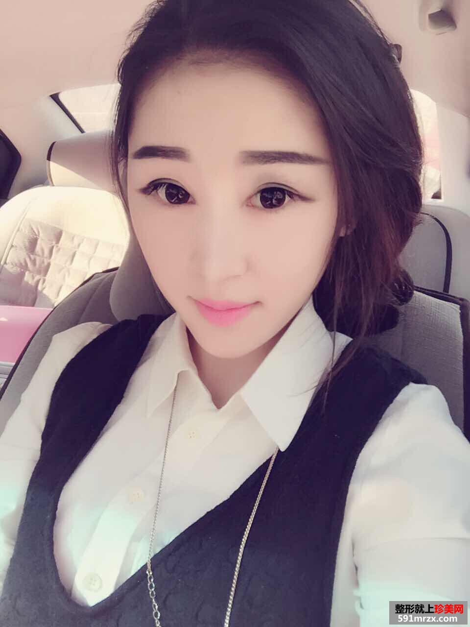 美女做玻尿酸丰苹果肌手术前后对比效果图片恢复过程分享