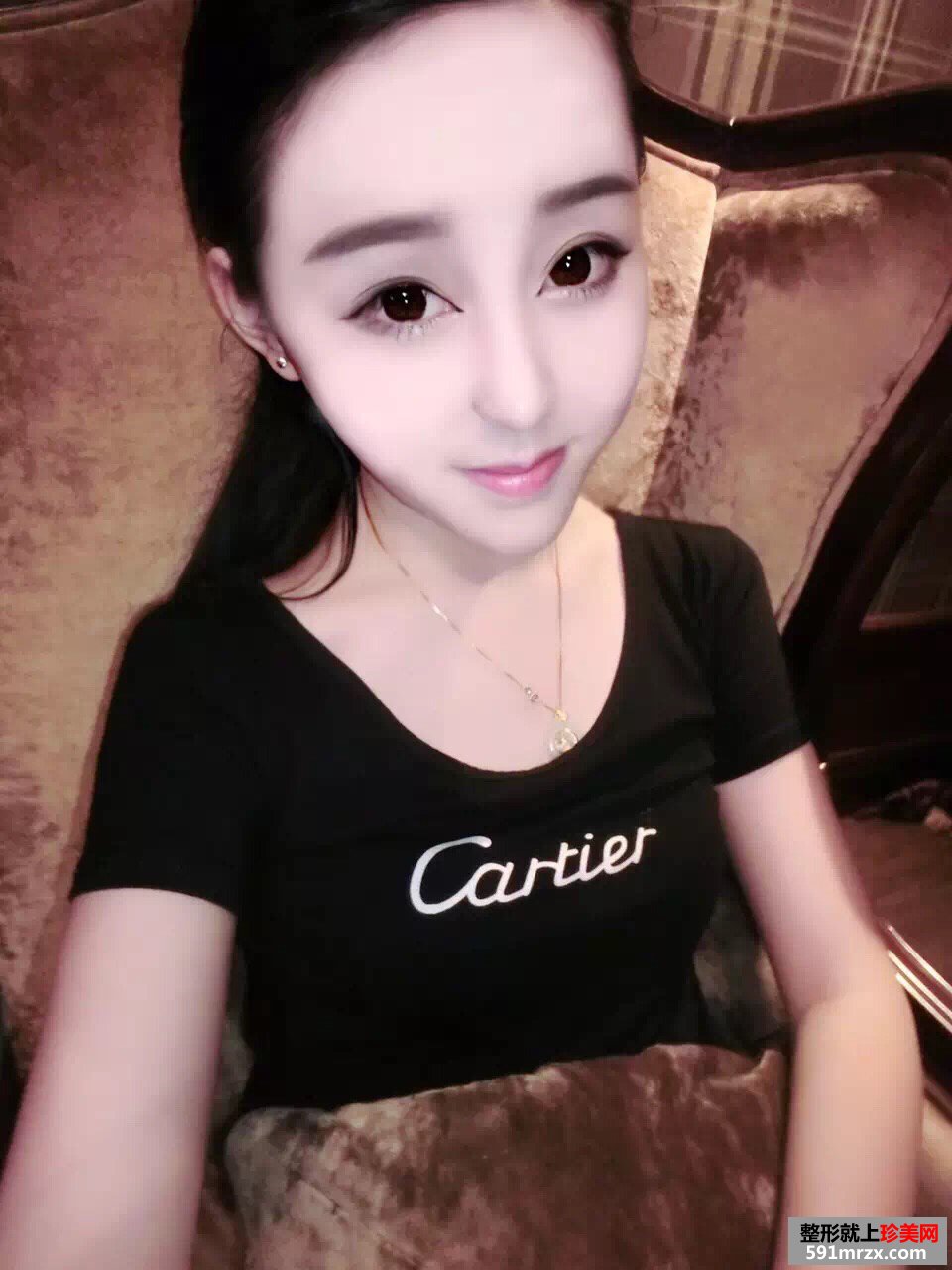 美女做玻尿酸丰苹果肌手术前后对比效果图片恢复过程分享