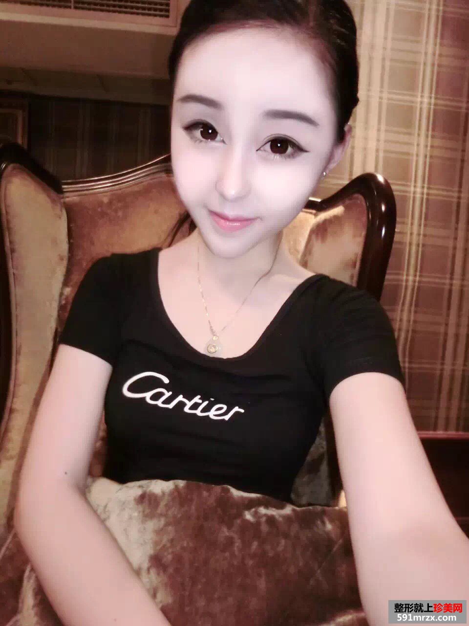美女做玻尿酸丰苹果肌手术前后对比效果图片恢复过程分享