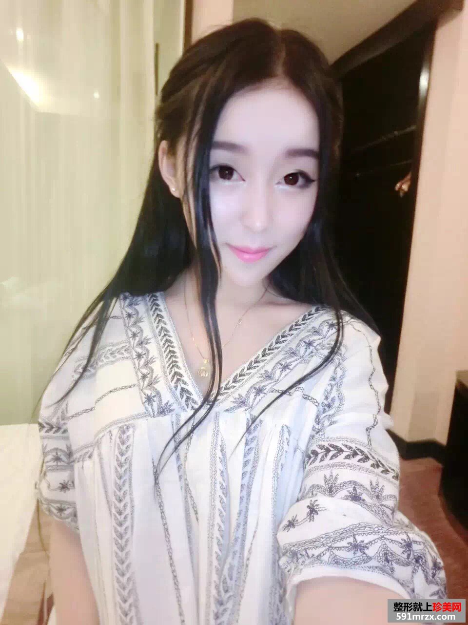美女做玻尿酸丰苹果肌手术前后对比效果图片恢复过程分享