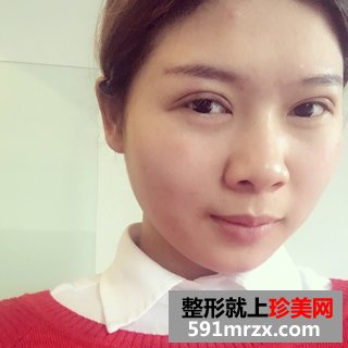埋线双眼皮恢复图片经历分享 北京华韩埋线双眼皮