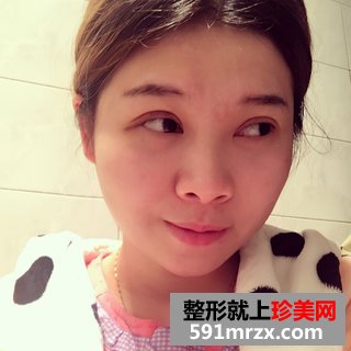 埋线双眼皮恢复图片经历分享 北京华韩埋线双眼皮