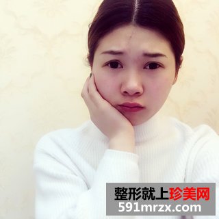 埋线双眼皮恢复图片经历分享 北京华韩埋线双眼皮