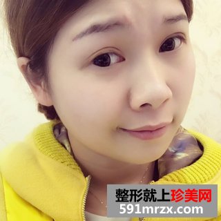 埋线双眼皮恢复图片经历分享 北京华韩埋线双眼皮
