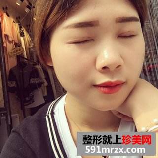 埋线双眼皮恢复图片经历分享 北京华韩埋线双眼皮