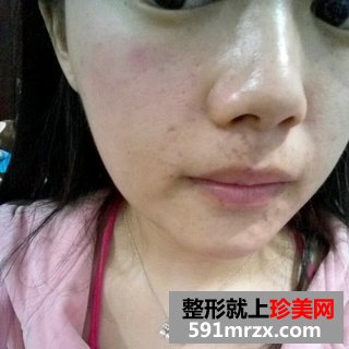 水光针效果图前后对比 北京俯大水光针注射