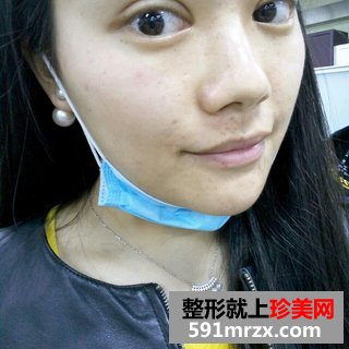 水光针效果图前后对比 北京俯大水光针注射