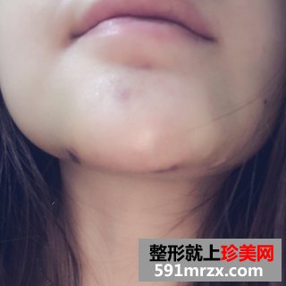 假体垫下巴恢复过程图 北京二炮假体垫下巴